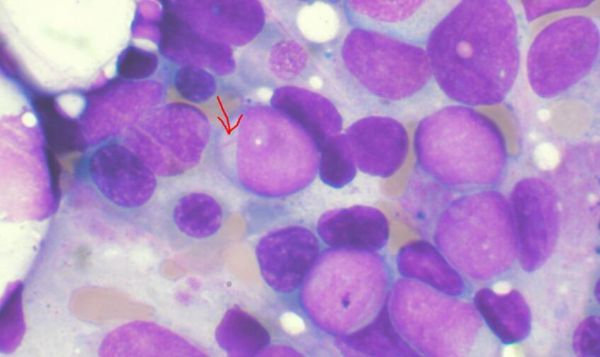 Cell：突破！科學家利用CRISPR/Cas9改造造血干細胞 促進CAR-T細胞療法有效治療<font color='red'>急性髓性白血病</font>