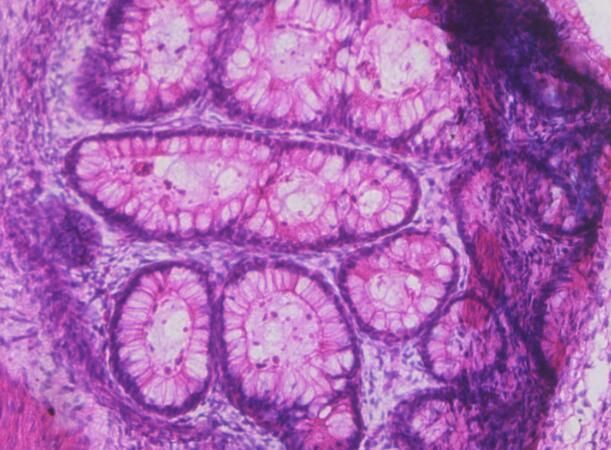 Cell Stem Cell：科學家利用畸胎瘤成功衍生出肌肉干細胞