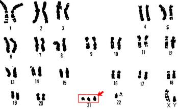 一種新型的敏感生物<font color='red'>傳感器</font>有望快速診斷唐氏綜合征