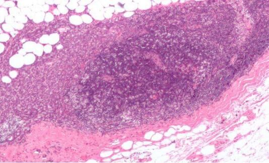 Cell Rep：科學家鑒別出參與乳腺癌細胞增殖及療法耐受性的關鍵酶類