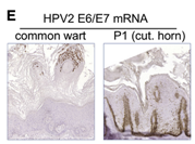 樹(shù)人綜合征患者為HPV-2感染