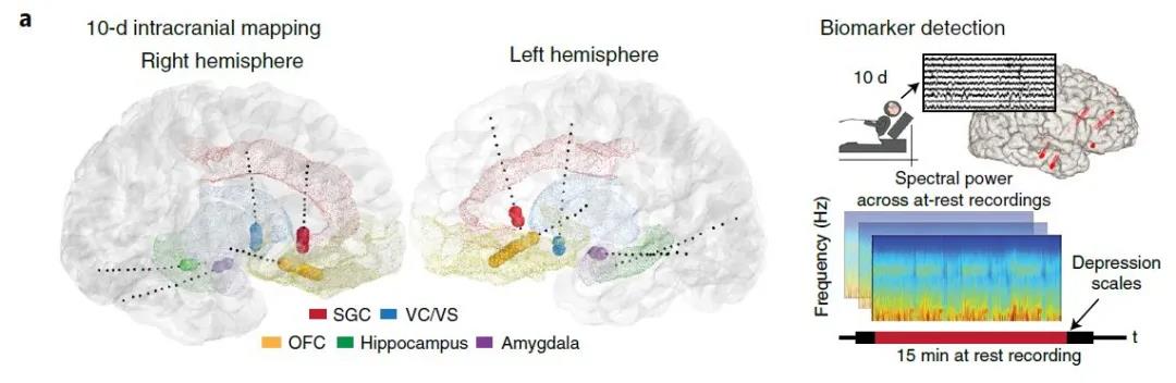 圖注：SEEG電極在大腦中的分布位置以及對生物標志物的檢測