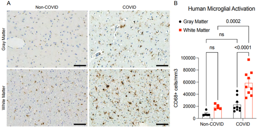 SARS-CoV-2感染后人白質小膠質細胞的反應性（圖源：bioRxiv）