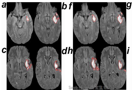 PLOS Med：計算機輔助診斷程序讓醫生更早發現腦腫瘤的生長