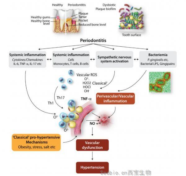 Cardiovasc Res：牙齦疾病與<font color='red'>高血壓</font>風險較高有關