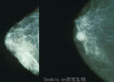 Mol Cancer Res：鑒別出關鍵靶點有望開發出治療三陰性乳腺癌的新型療法