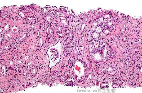 NEJM重大進展：乳腺癌藥物治療<font color='red'>前列腺癌</font>比標準療法更有效！