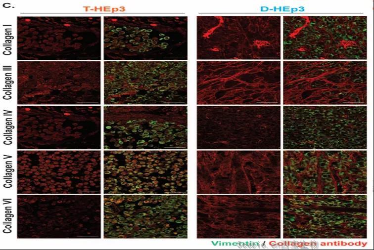 讓<font color='red'>癌細胞</font>“一睡不醒”！向腫瘤微環境中添加III型膠原蛋白可防止腫瘤復發和轉移