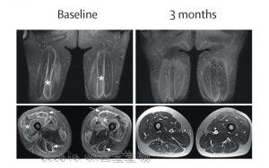 《柳葉刀》：首次成功利用CAR-T細胞治療嚴重肌肉炎癥