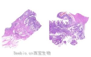 研究揭示了同時發生APC和MLH1種系突變的結直腸腫瘤的體細胞突變譜