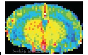 Nature Neuroscience：一種免疫蛋白可能誘發(fā)與高血壓無關的癡呆