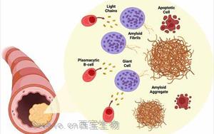 NEJM綜述：淀粉樣變性的發(fā)病機(jī)制、研究和治療