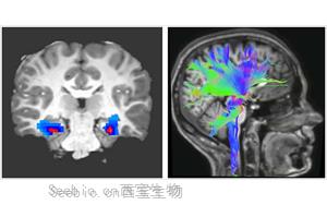 Nature Medicine：一種新的強迫癥神經<font color='red'>生物標志物</font>